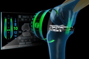 Newton™ Balanced Knee System