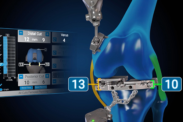 Newton™ Balanced-Knee-System